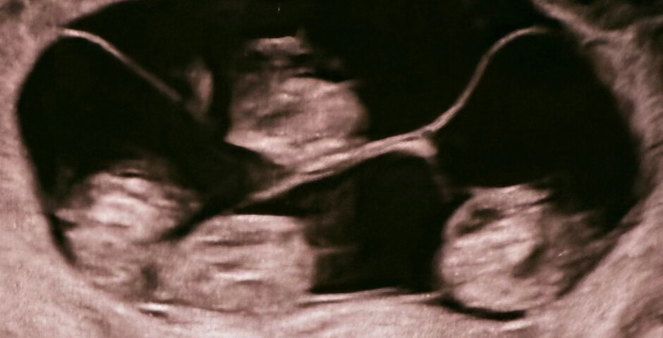 Жительница Петербурга первой в России родила однояйцевую четверню